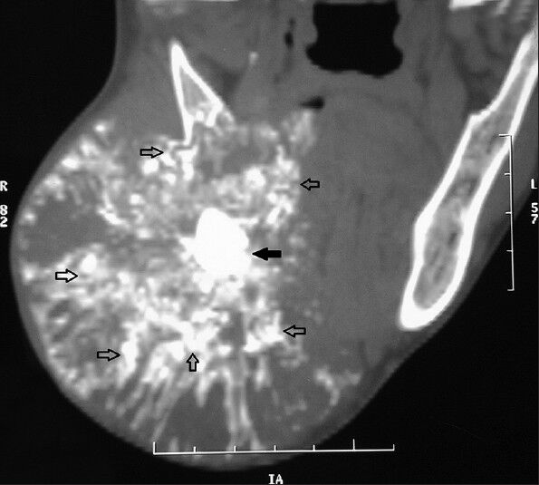 38-year-old female patient with a huge swelling on the right side of the face diagnosed with calcifying epithelial odontogenic tumor. Coronal view computed tomography scan shows a well-defined heterodense tumor mass on the right mandible having a central irregular hyperdense mass (solid black arrow) with multiple irregular calcifications with a “snow flake” pattern (black outline arrows).